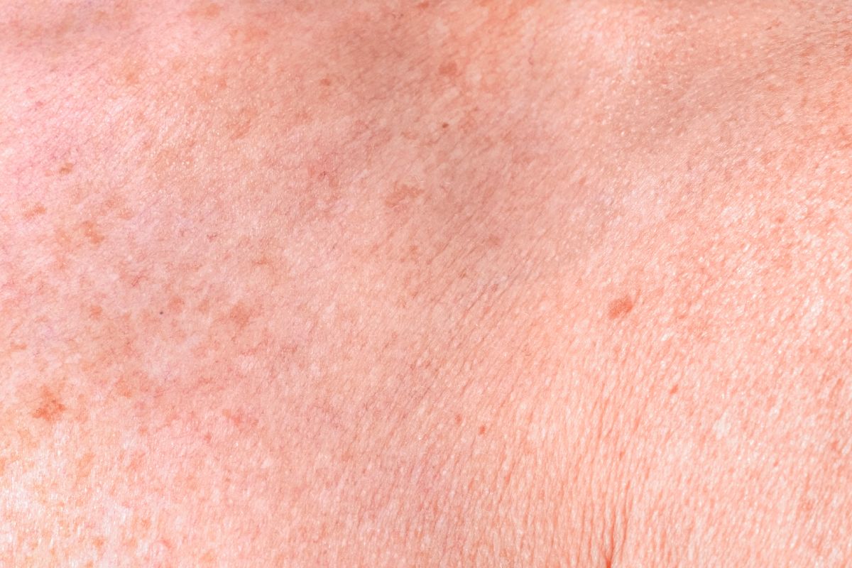 Aging female skin with melasma spots